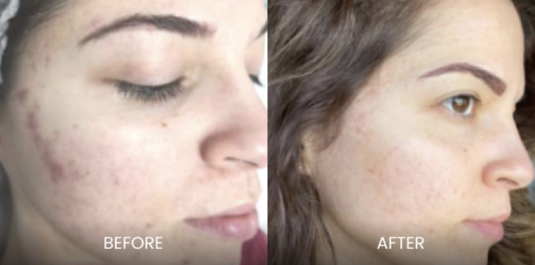 Acne Micropricking
